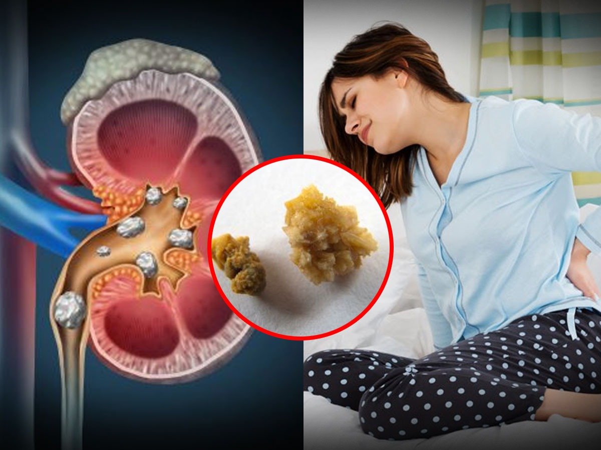 Renal Stones Treatment